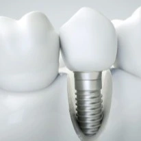 implant