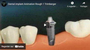 Implants dentaires