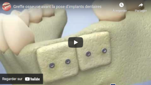 Greffe osseuse avant pose d'implants