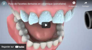Pose de Facettes dentaires en céramique (porcelaine)