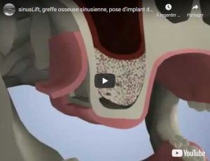 Implant dentaire : sinus lift