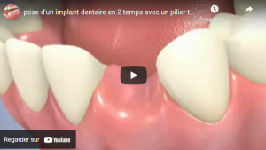 Pose d'implant dentaire - Pilier en titane