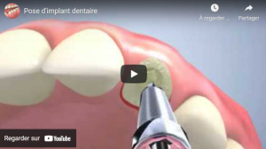 Pose d'implant dentaire