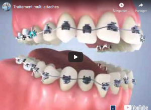 Traitement multi attaches